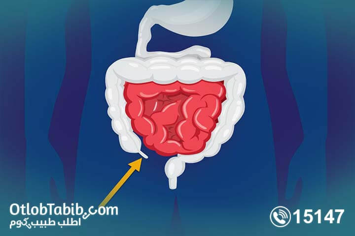 اعراض الزائده الملتهبه