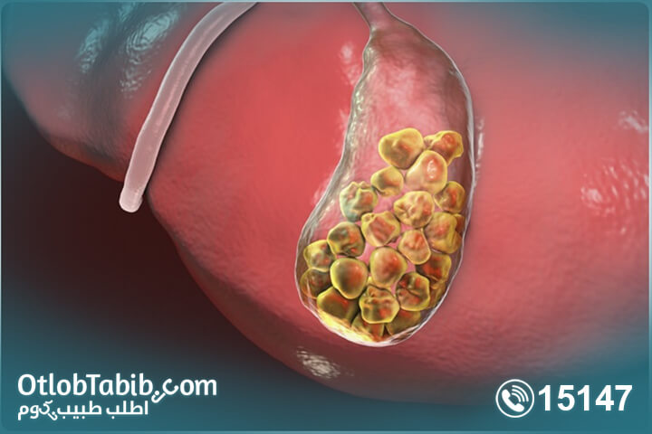 اسباب-حصوة-المرارة