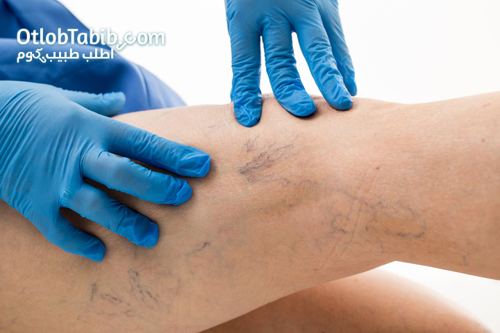 Varicose veins - Your legs need rest!