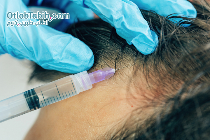 Mesotherapy injection as a treatment for hair loss