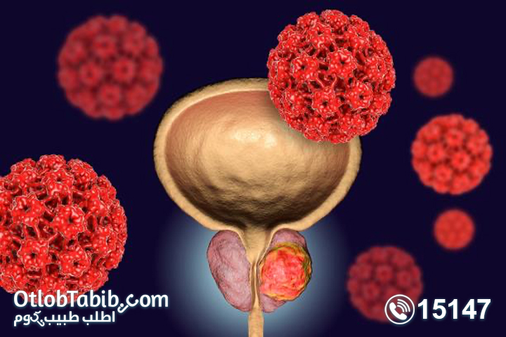 اعراض سرطان البروستاتا وماهي دلالات اورام البروستاتا