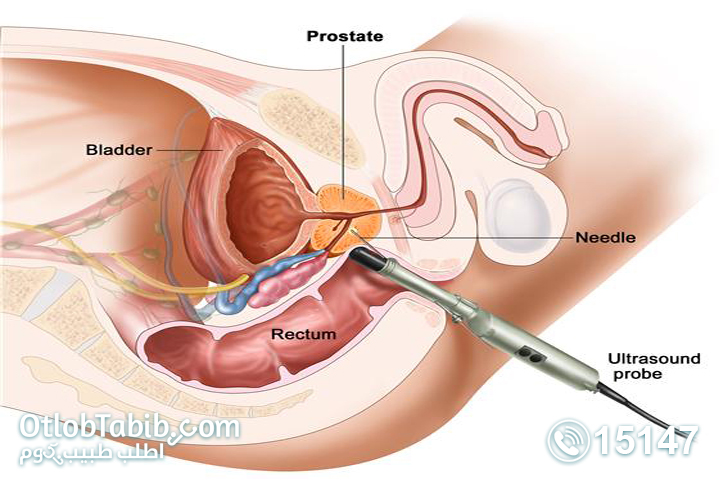 Prostatitis and how to treat prostatitis permanently
