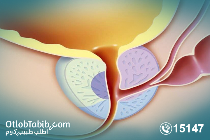 تعرف على اسباب التهاب البروستاتا والأعراض والأنواع