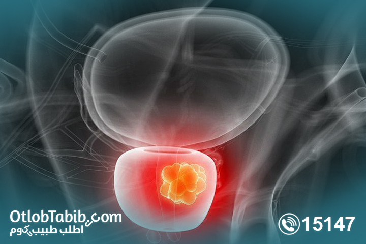 Are you at risk for prostate congestion? Know the causes of gland congestion