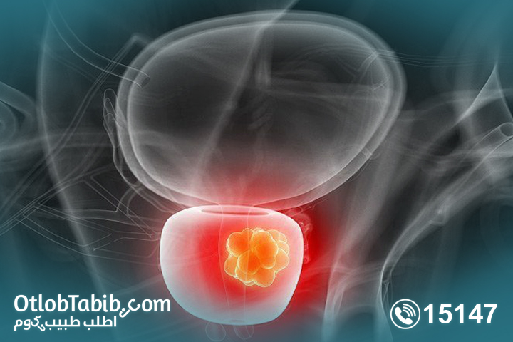 هل أنت معرض لـ احتقان البروستاتا ؟ إعرف أسباب احتقان الغدة