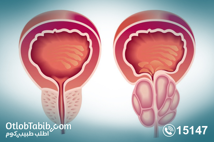 What is the relationship of prostate enlargement to your sex life?