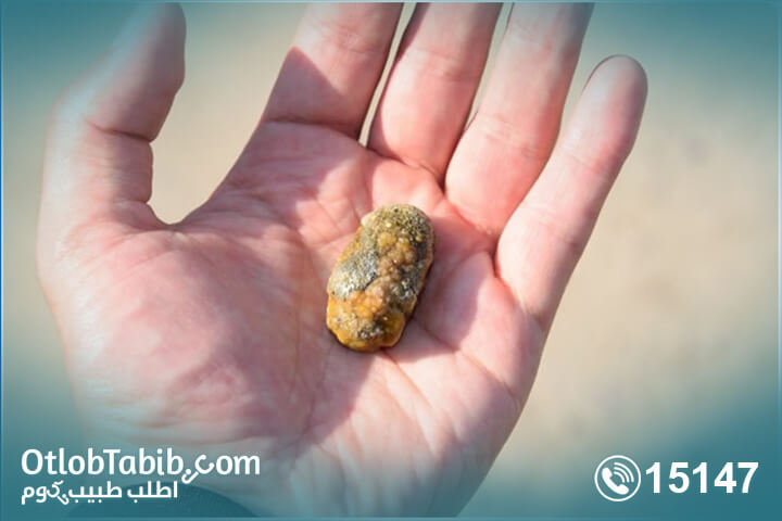 Wondering about gallstone? Know the answers with Otlob Tabib