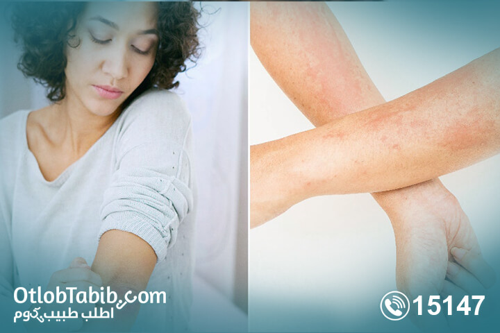 All you need to know about urticaria with Otlob Tabib