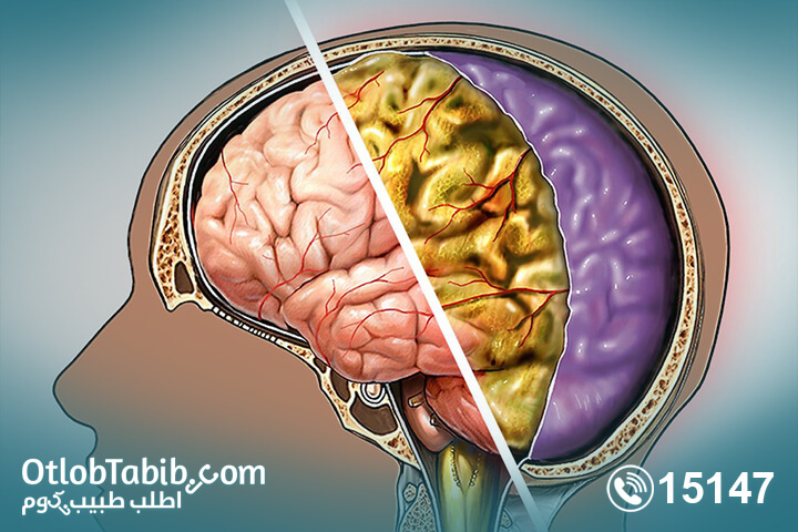 What is meningitis? Know more and 10 tips to prevent it