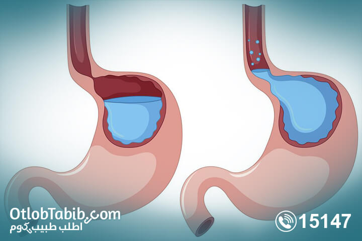 Gastroesophageal reflux symptoms to end! Know more about it