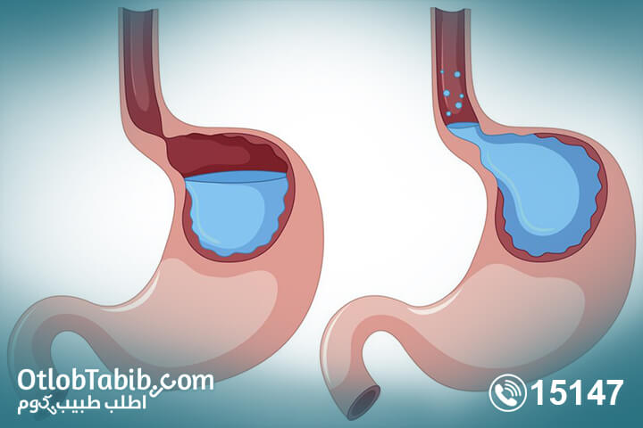 اعراض ارتجاع المرئ عليها أن تنتهي! إعرف ما هو ارتجاع المرئ