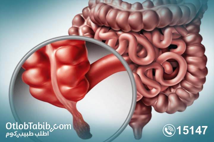 متى تقلق بشأن اعراض الزائدة ؟ إعرف كافة التفاصيل الآن!