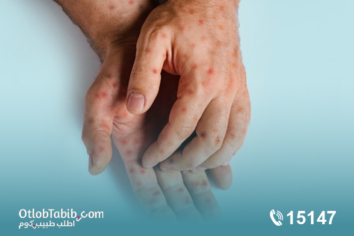 عدوى فيروس جدري القرود ما هي؟