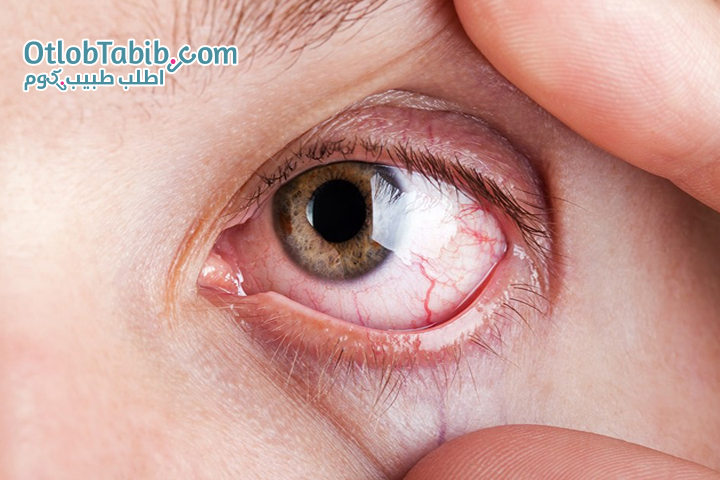 Spring conjunctivitis .. its causes and methods of prevention