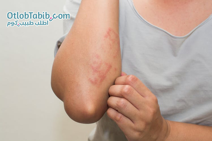 Simple tips to relieve eczema symptoms